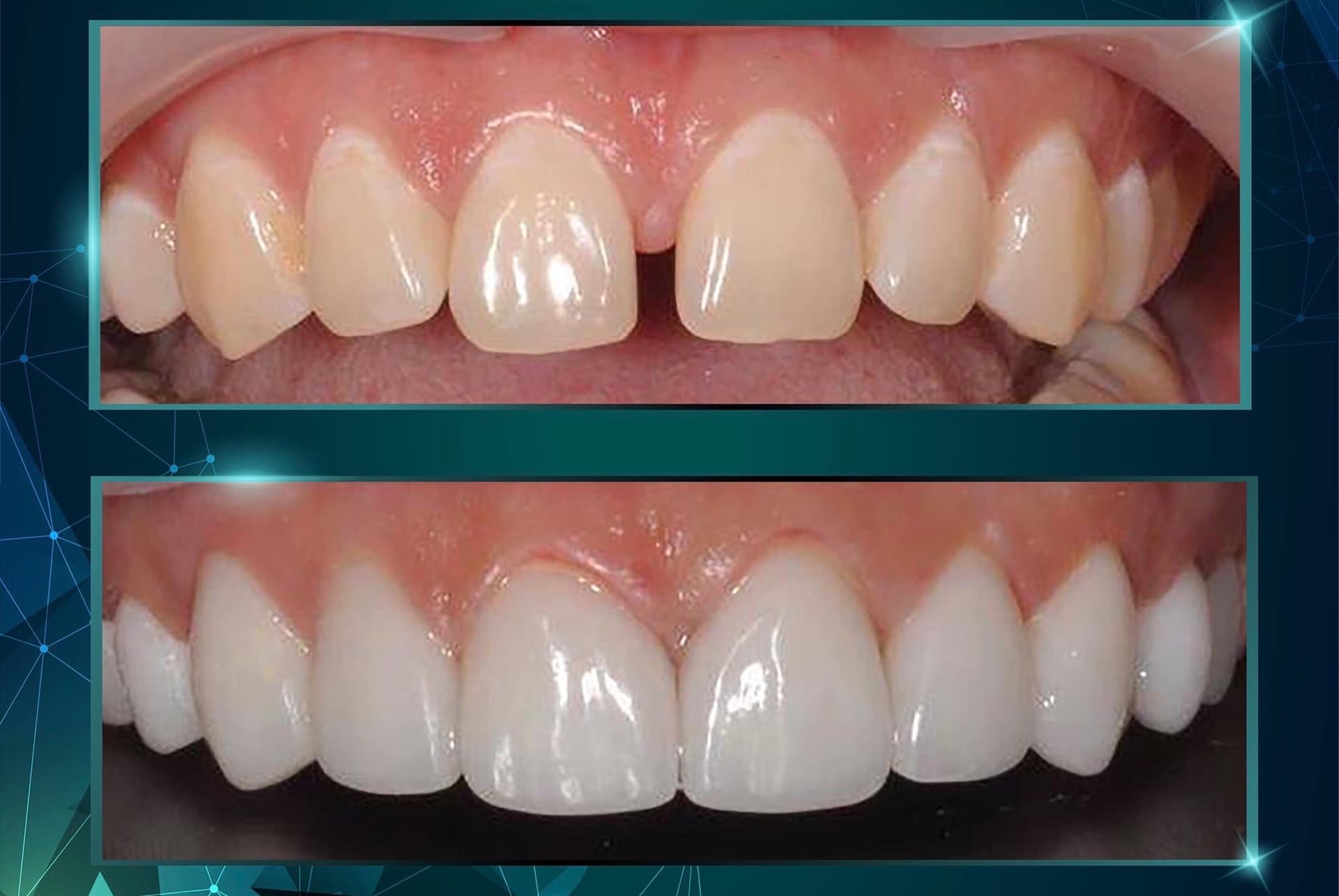 Dán Răng Sứ - Giữ 100% Răng Gốc