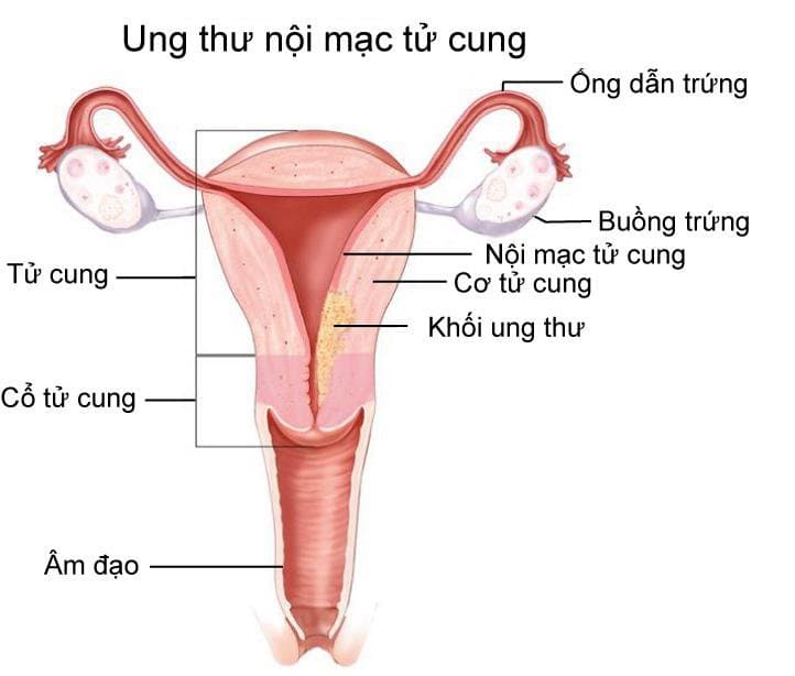 Ung thư nội mạc tử cung là gì? và cách phát hiện