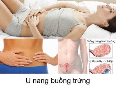 U nang buồng trứng kích thước bao nhiêu thì mổ