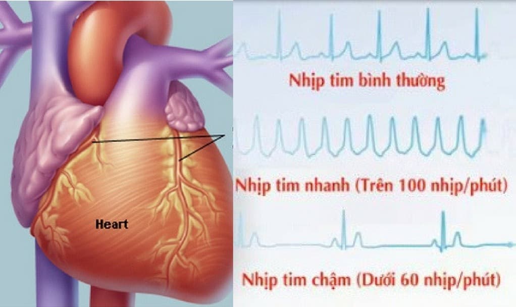 Rối loạn nhịp tim và cách điều trị hiệu quả