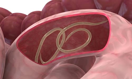 Chẩn đoán giun bằng phương pháp siêu âm