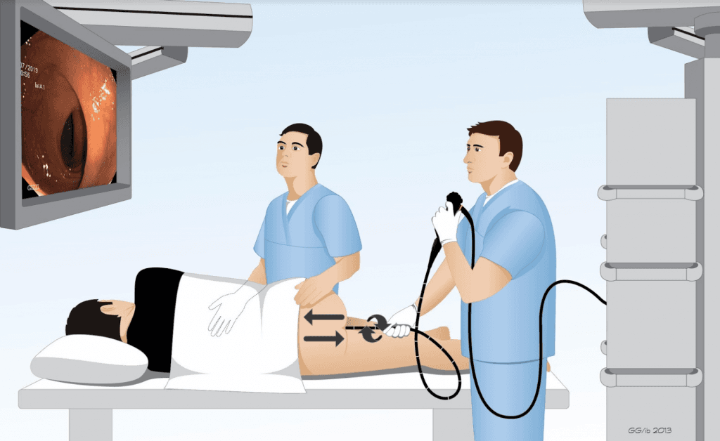 Nội soi dạ dày và nội soi đại tràng có gây mê