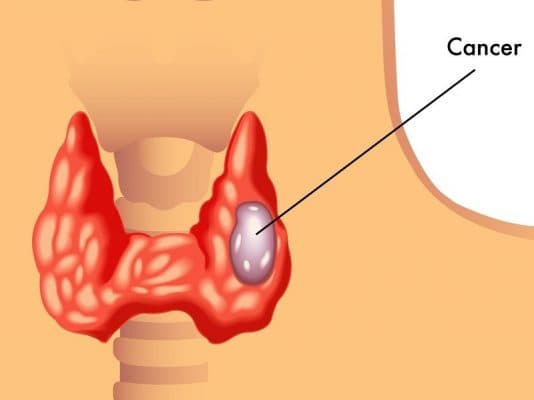 Phương pháp chẩn đoán bệnh ung thư tuyến giáp