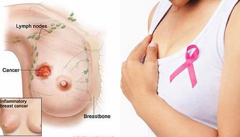 Lựa chọn điều trị ung thư vú giai đoạn III