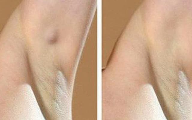 Cảnh giác ung thư vú nếu nổi u hạch ở nách