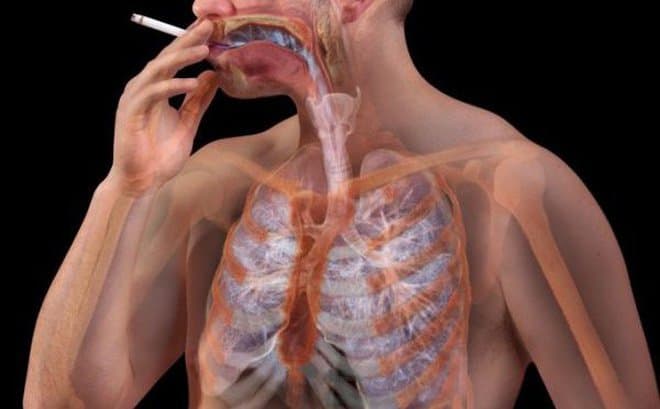 Bị giãn phế quản sau lao phổi