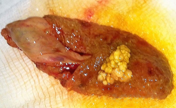 Sỏi túi mật là bệnh gì? Nguyên nhân, triệu chứng, chẩn đoán và cách xử trí