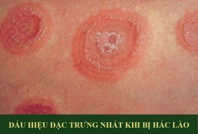 Cách chữa bệnh hắc lào tại nhà