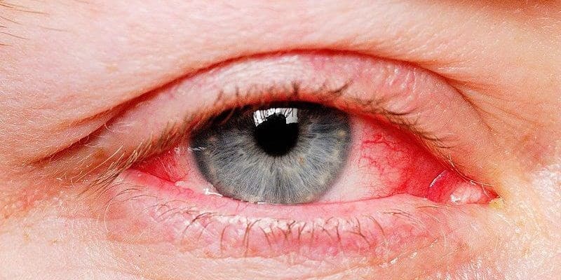 Cách chăm sóc cho trẻ bị đau mắt đỏ tại nhà như thế nào?