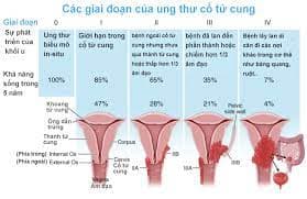 Tìm hiểu Các giai đoạn ung thư cổ tử cung
