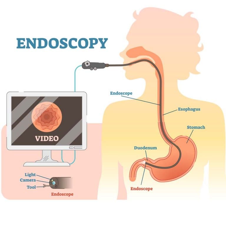 Bảng giá dich vụ Nội Soi Tiêu Hóa tại Bệnh viện ung bướu Hưng Việt