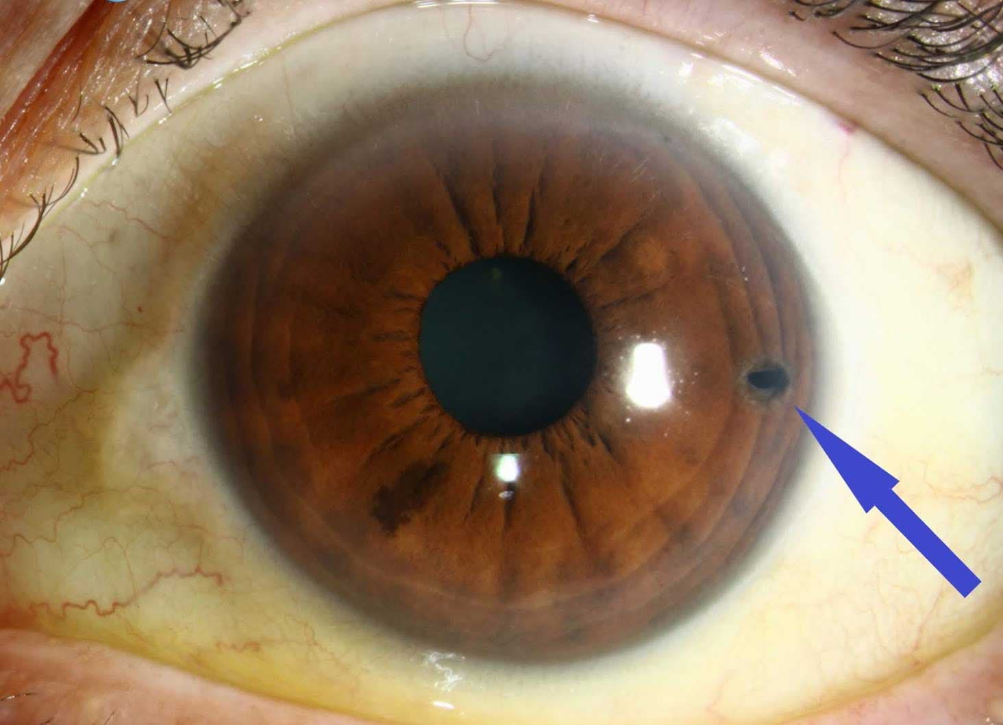 Cắt mống mắt chu biên bằng Laser - Mắt Đông Đô