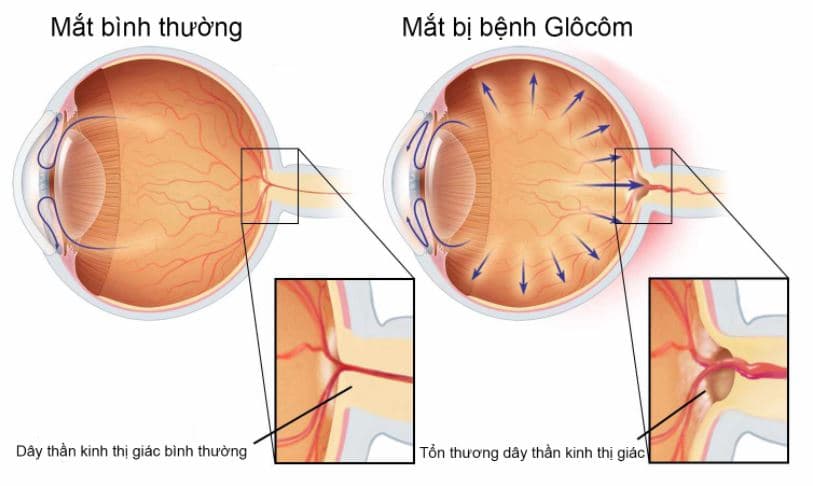 Phẫu thuật tạo hình vùng bè bằng tia laser - Mắt đông đô