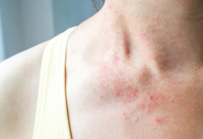 giá xét nghiệm 60 dị nguyên tại medlatec