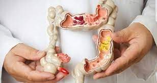 Gói Tầm soát ung thư đại trực tràng Bệnh viện Vinmec Timecity