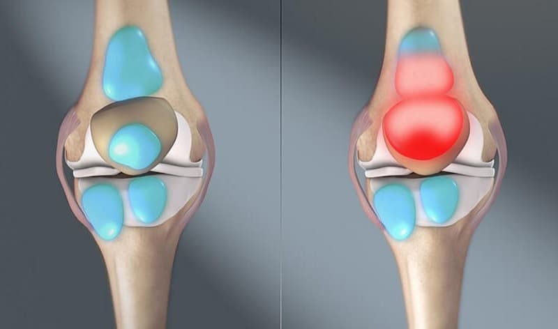 Địa chỉ tư nhân khám chữa Tràn dịch khớp gối tại Hà Nội