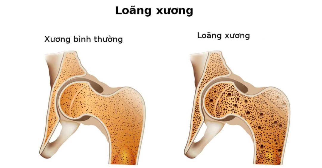 TOP 5 địa chỉ y tế tư nhân khám chữa loãng xương hàng đầu tại Hà Nội