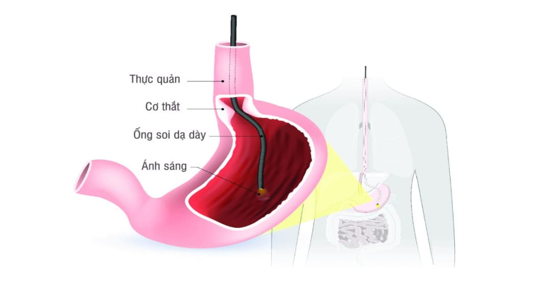 5 Địa Chỉ Nội Soi Dạ Dày Uy Tín Nhất Tại Hà Nội