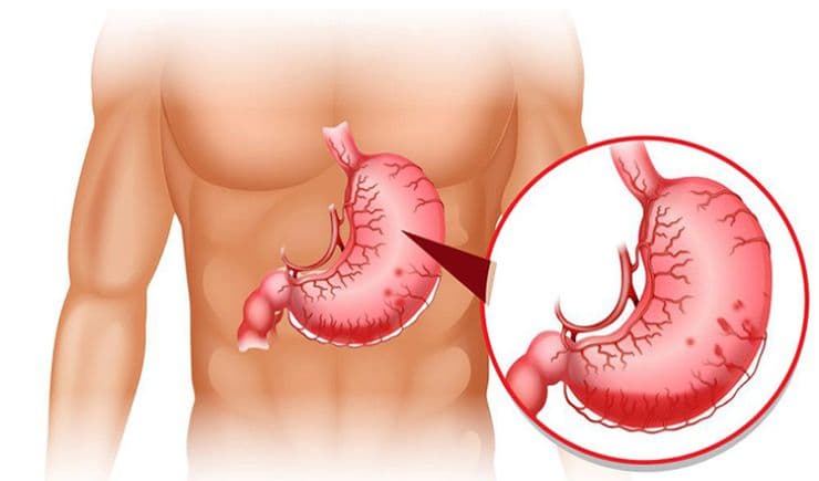 Các bác sĩ nội soi tiêu hóa điều trị đau dạ dày xuất sắc tại Hà Nội