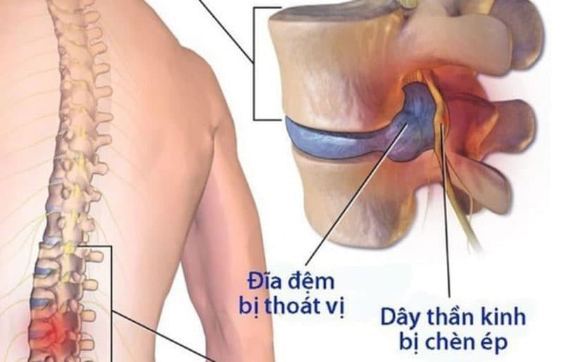 Chuyên Gia Điều Trị Thoát Vị Đĩa Đệm Hàng Đầu Tại Hà Nội