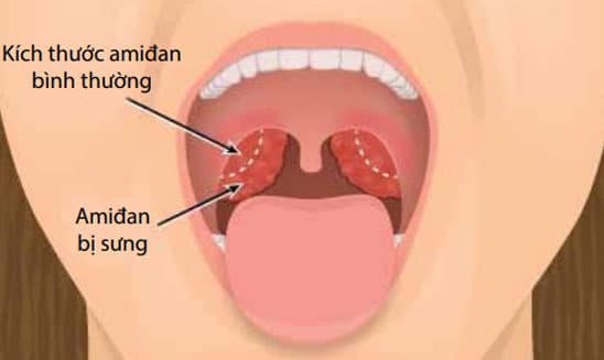 Chi phí cắt Amidan bằng công nghệ dao Plasma tại Hà Nội là bao nhiêu?