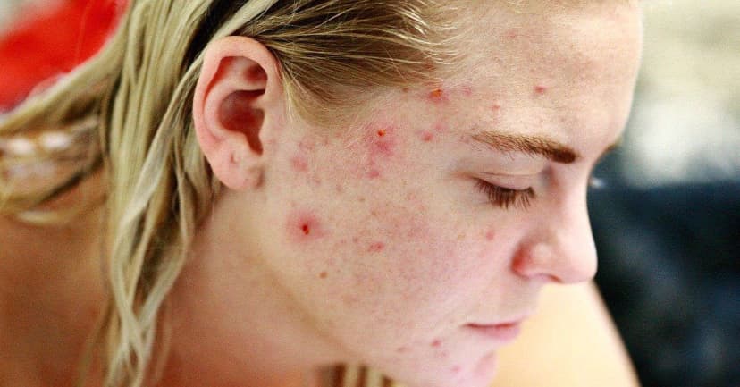 5 Cơ sở y tế hàng đầu tại Hà Nội chuyên điều trị mụn hiệu quả và uy tín