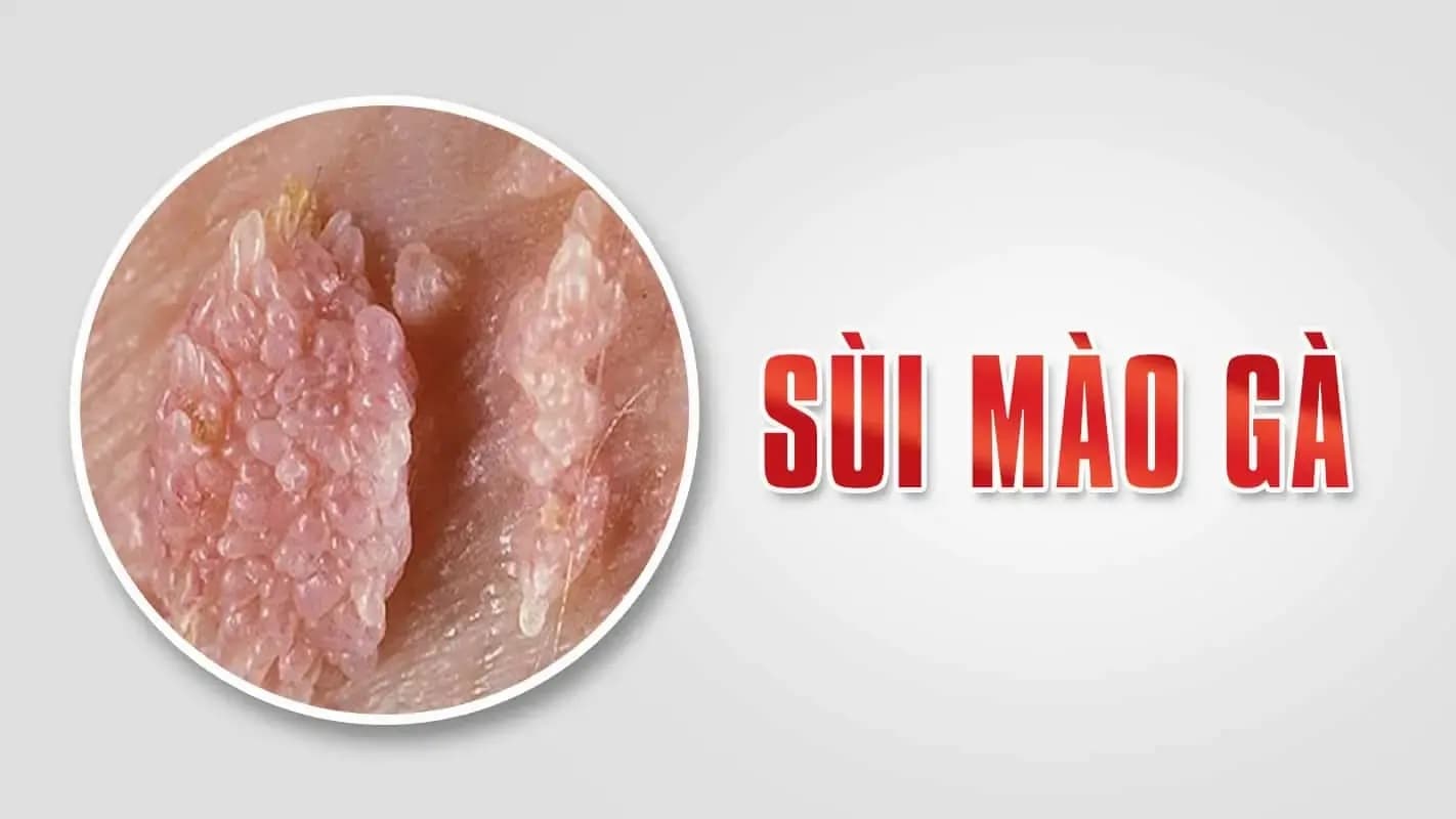 Chi phí điều trị sùi mào gà: Cập nhật bảng giá từ 4 cơ sở uy tín tại Hà Nội
