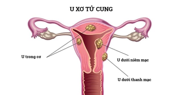 Tìm địa chỉ uy tín để khám và điều trị u xơ tử cung tại Hà Nội ở đâu?
