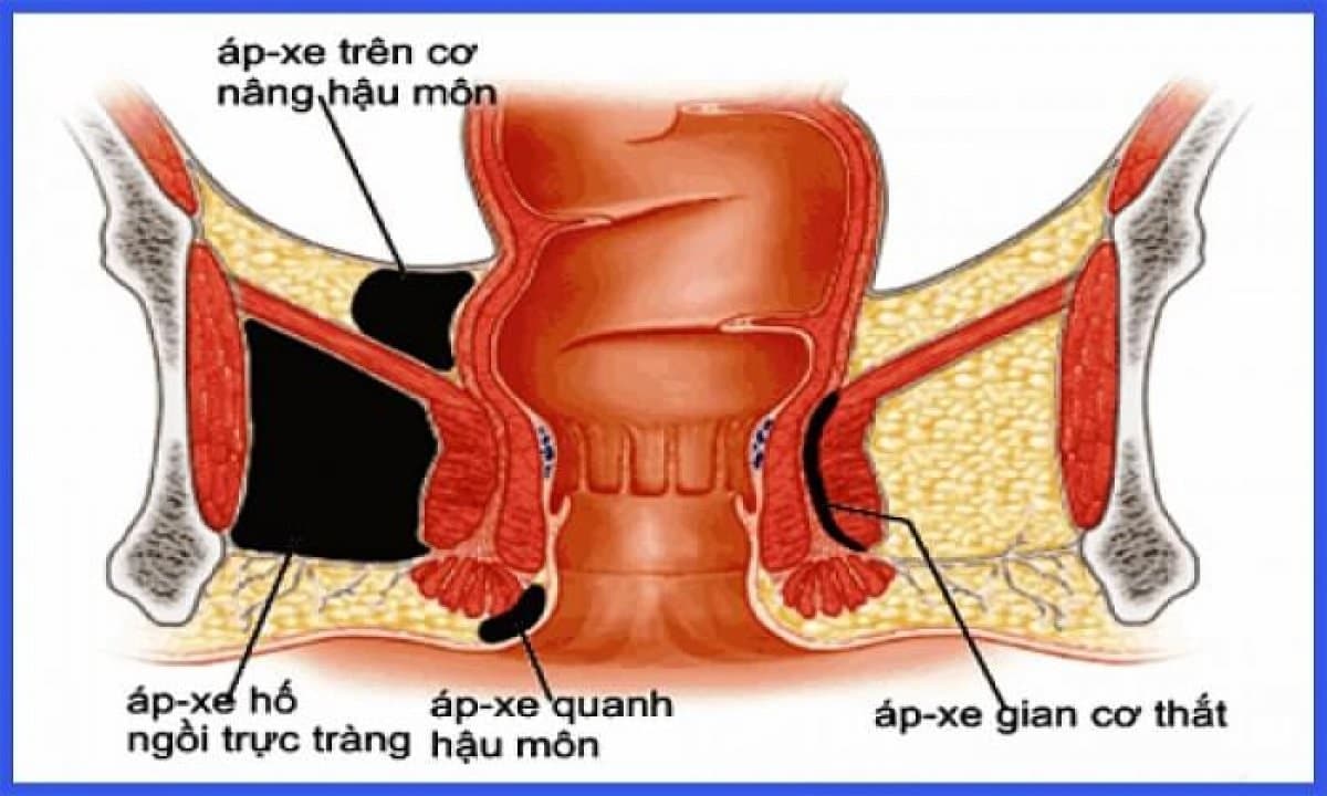 8 bác sĩ hàng đầu trong khám và điều trị áp xe hậu môn tại Hà Nội