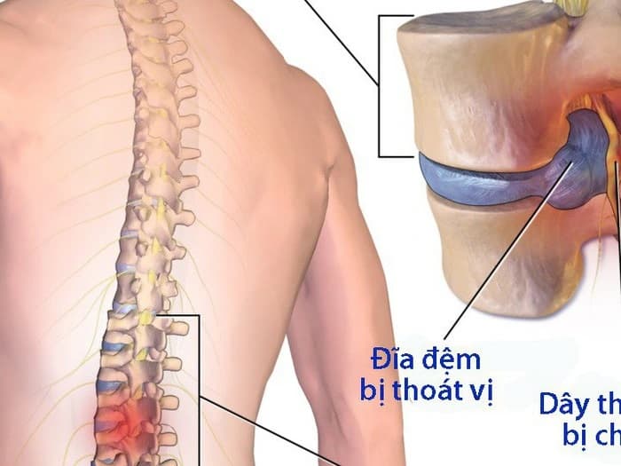 Địa chỉ khám và điều trị bệnh thoát vị đĩa đệm uy tín tại Hà Nội