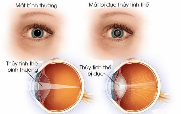 7 địa chỉ uy tín tại Hà Nội khám và phẫu thuật đục thủy tinh thể bằng Phaco