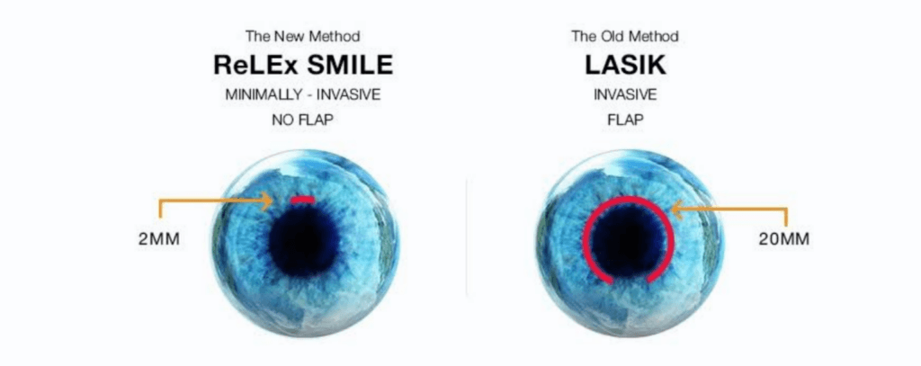 Chi phí phẫu thuật mắt ReLEx SMILE tại 5 cơ sở y tế uy tín tại Hà Nội