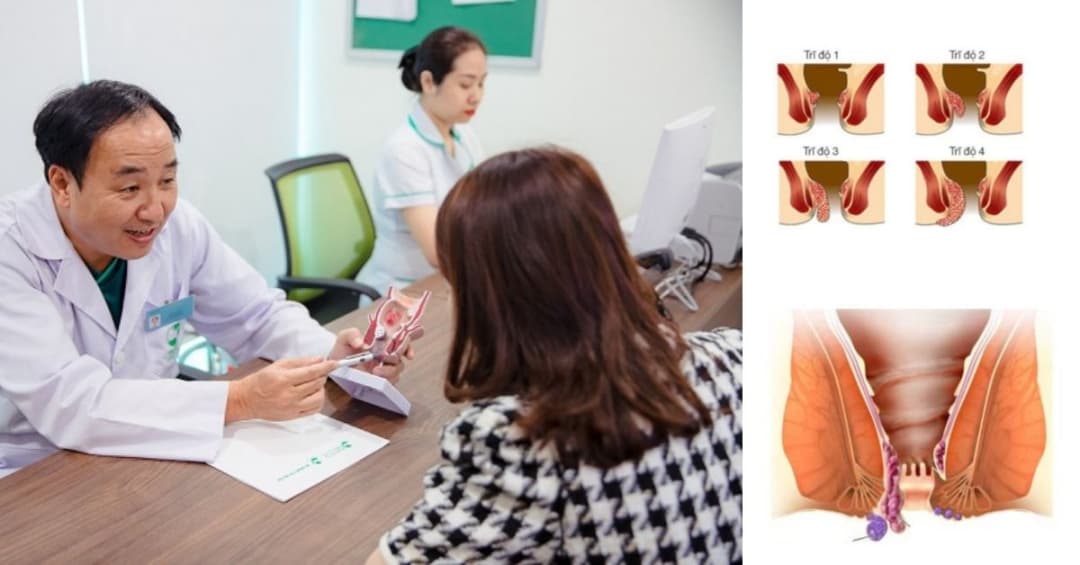 7 cơ sở y tế uy tín tại Hà Nội chuyên điều trị bệnh trĩ
