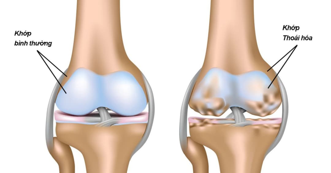 6 chuyên gia điều trị thoái hóa khớp hàng đầu tại Hà Nội