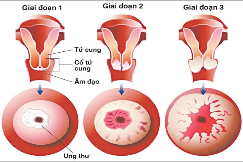 5 địa chỉ khám và điều trị ung thư cổ tử cung uy tín tại Hà Nội