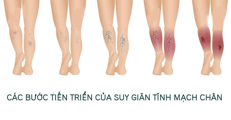Đánh giá các địa chỉ tầm soát suy giãn tĩnh mạch hàng đầu tại Hà Nội