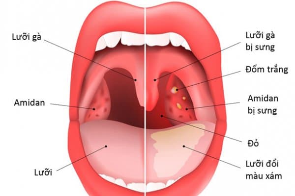 4 Bác sĩ Điều trị Viêm Amidan Hàng đầu tại Hà Nội