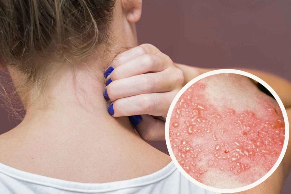 Top 10 bác sĩ hàng đầu điều trị bệnh zona thần kinh tại Hà Nội