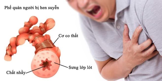 5 Địa Chỉ Khám Chữa Hen Phế Quản Uy Tín Tại Hà Nội