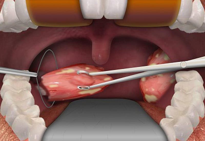 Chi phí cắt Amidan tại TPHCM: Tổng hợp 5 địa chỉ uy tín