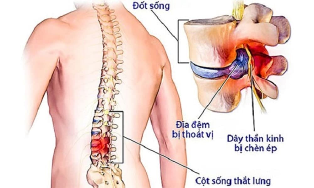 6 địa chỉ bệnh viện, phòng khám chữa thoát vị đĩa đệm uy tín tại Hà Nội
