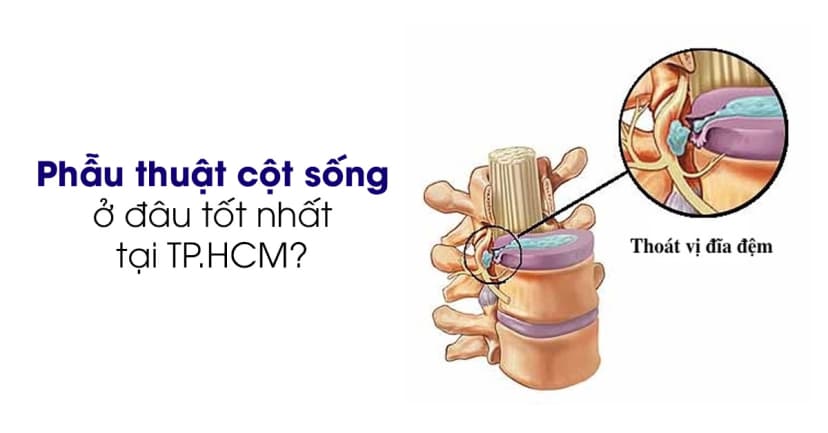 Địa chỉ phẫu thuật cột sống uy tín tại TP.HCM