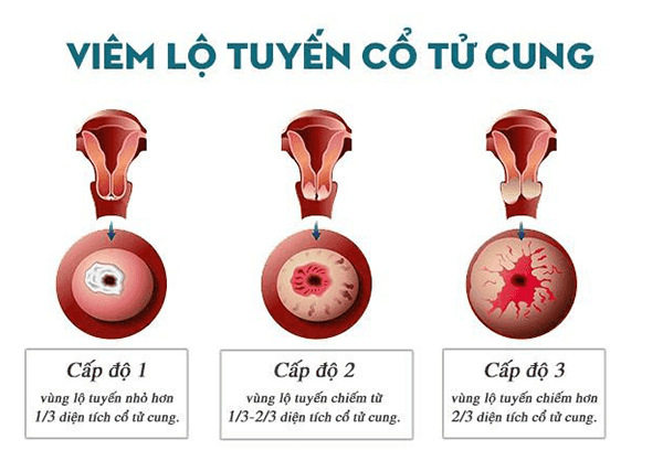 Top 5 bác sĩ chuyên khám và điều trị Viêm lộ tuyến cổ tử cung tại Hà Nội