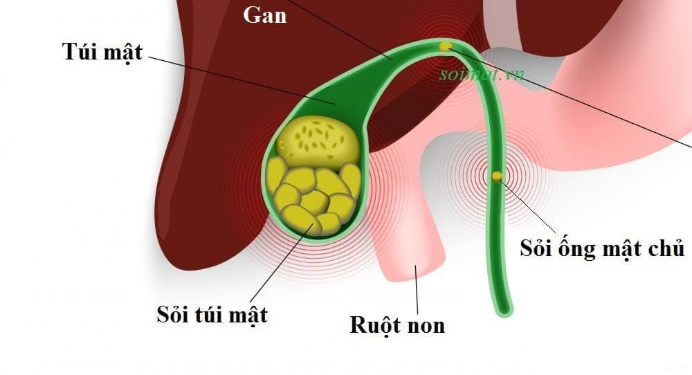 6 Bác Sĩ Phẫu Thuật Sỏi Mật Xuất Sắc Tại Hà Nội