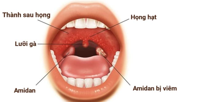 5 Bệnh Lý Thường Gặp Ở Họng Và Cách Phòng Tránh