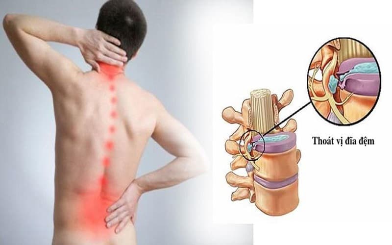 6 Bác Sĩ Chuyên Chữa Thoát Vị Đĩa Đệm Xuất Sắc Tại TP.HCM
