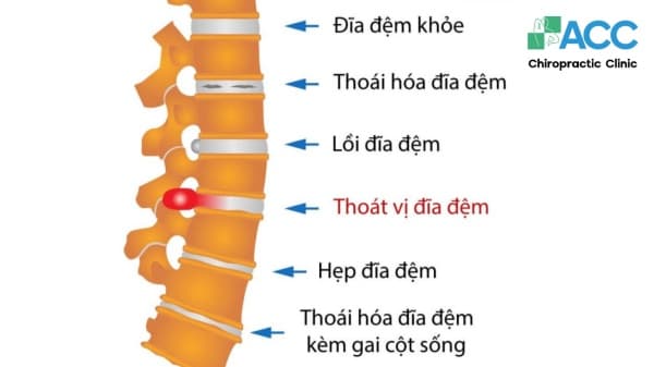 Thoát vị đĩa đệm: Có thể chữa trị không? Khi nào cần can thiệp?