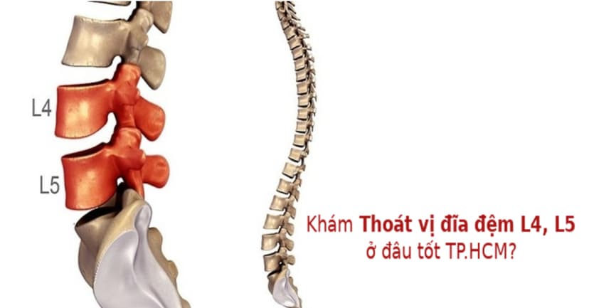 Địa chỉ Khám và Điều Trị Thoát Vị Đĩa Đệm L4 L5 Tốt Nhất Tại TP.HCM