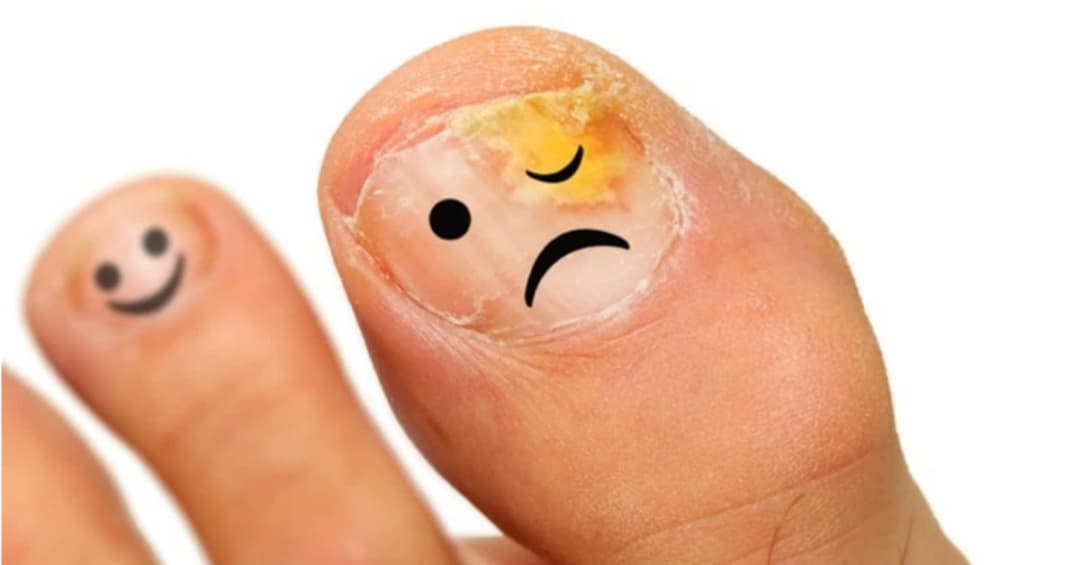 Địa chỉ khám và điều trị nấm móng tay, nấm móng chân chất lượng tại TP.HCM