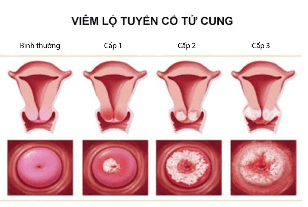 5 Bác Sĩ Chuyên Khám Chữa Viêm Lộ Tuyến Cổ Tử Cung Tốt Nhất Tại Hà Nội